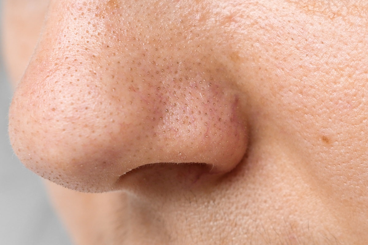 Comment se débarrasser des points noirs sur le nez